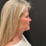 Facelift Before & After Patient #6493