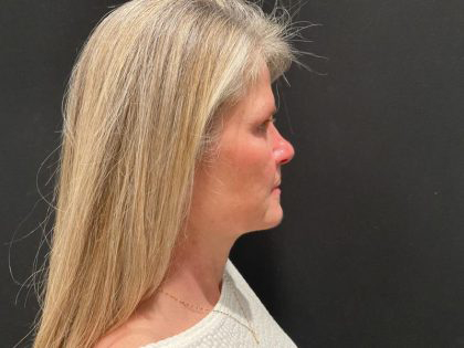 Facelift Before & After Patient #6493