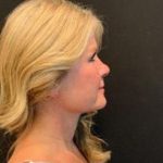 Facelift Before & After Patient #6493