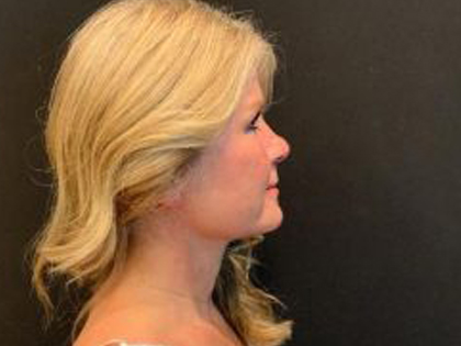 Facelift Before & After Patient #6493