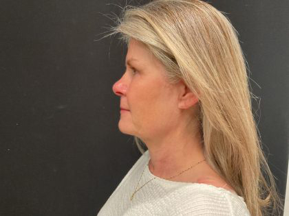 Facelift Before & After Patient #6493