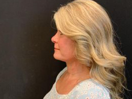 Facelift Before & After Patient #6493