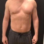 Liposuction Before & After Patient #6939