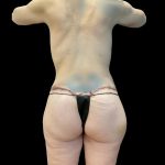 Butt Lift Before & After Patient #8123