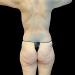 Butt Lift Before & After Patient #8123