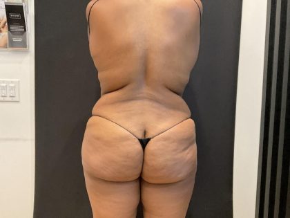 Liposuction Before & After Patient #8043