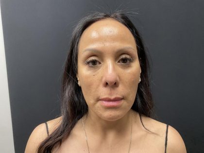 Liquid Rhinoplasty Before & After Patient #8078