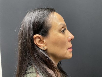 Liquid Rhinoplasty Before & After Patient #8078