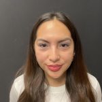 Liquid Rhinoplasty Before & After Patient #8077