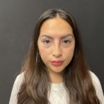Liquid Rhinoplasty Before & After Patient #8077
