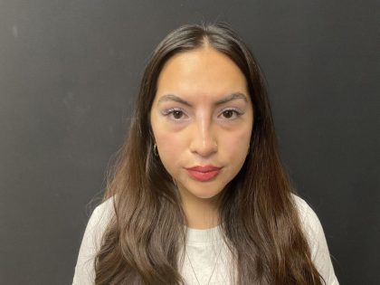 Liquid Rhinoplasty Before & After Patient #8077