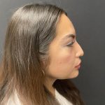 Liquid Rhinoplasty Before & After Patient #8077