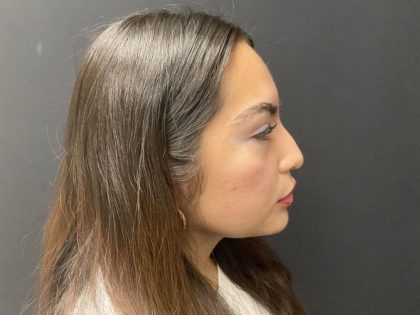 Liquid Rhinoplasty Before & After Patient #8077