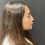 Liquid Rhinoplasty Before & After Patient #8077