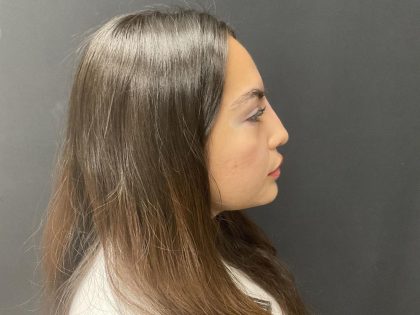 Liquid Rhinoplasty Before & After Patient #8077