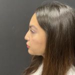 Liquid Rhinoplasty Before & After Patient #8077