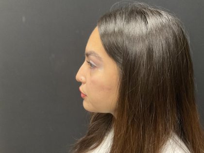 Liquid Rhinoplasty Before & After Patient #8077