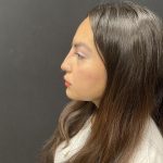 Liquid Rhinoplasty Before & After Patient #8077