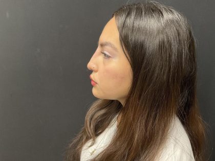 Liquid Rhinoplasty Before & After Patient #8077