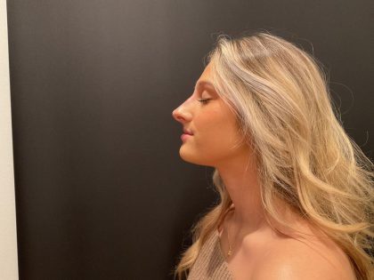 Liquid Rhinoplasty Before & After Patient #8076