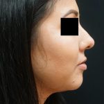 Liquid Rhinoplasty Before & After Patient #8075