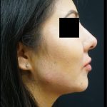 Liquid Rhinoplasty Before & After Patient #8075