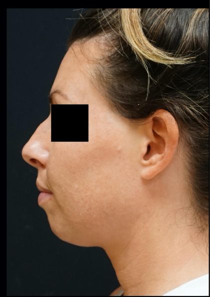 Liquid Rhinoplasty Before & After Patient #8074