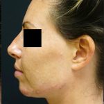 Liquid Rhinoplasty Before & After Patient #8074