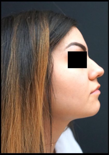 Liquid Rhinoplasty Before & After Patient #8073