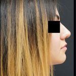 Liquid Rhinoplasty Before & After Patient #8073