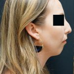 Liquid Rhinoplasty Before & After Patient #8072