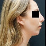 Liquid Rhinoplasty Before & After Patient #8072