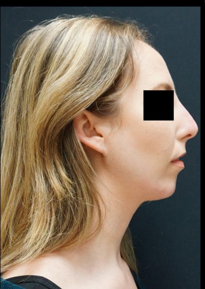 Liquid Rhinoplasty Before & After Patient #8072