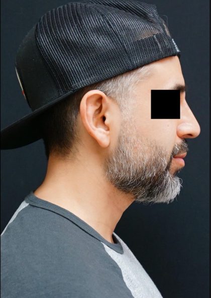 Liquid Rhinoplasty Before & After Patient #8071