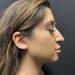 Liquid Rhinoplasty Before & After Patient #8070