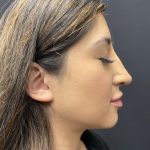 Liquid Rhinoplasty Before & After Patient #8070