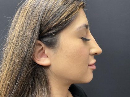 Liquid Rhinoplasty Before & After Patient #8070