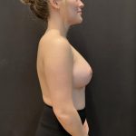 Breast Augmentation Before & After Patient #8198