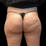 Brazilian Butt Lift Before & After Patient #8150