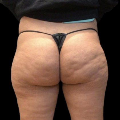 Brazilian Butt Lift Before & After Patient #8150