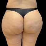 Brazilian Butt Lift Before & After Patient #8150