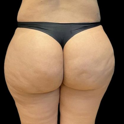Brazilian Butt Lift Before & After Patient #8150