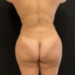 Brazilian Butt Lift Before & After Patient #8170