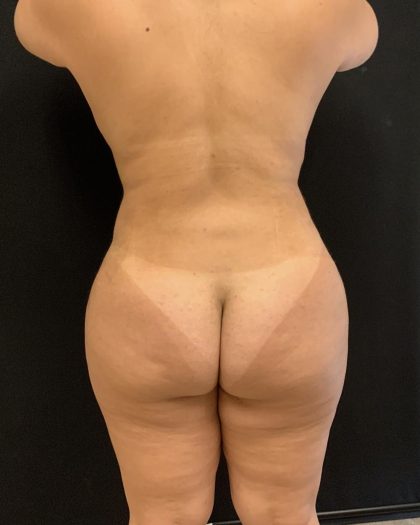 Brazilian Butt Lift Before & After Patient #8170