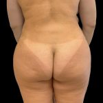 Brazilian Butt Lift Before & After Patient #8170