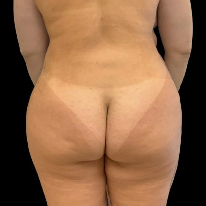 Brazilian Butt Lift Before & After Patient #8170
