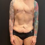 Body Lift Before & After Patient #8098