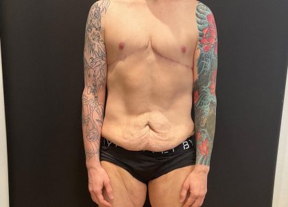 Body Lift Before & After Patient #8098