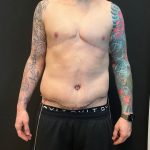 Body Lift Before & After Patient #8098