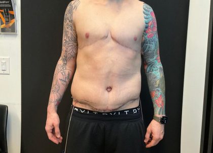 Body Lift Before & After Patient #8098